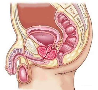A cystitis okai a férfiakban
