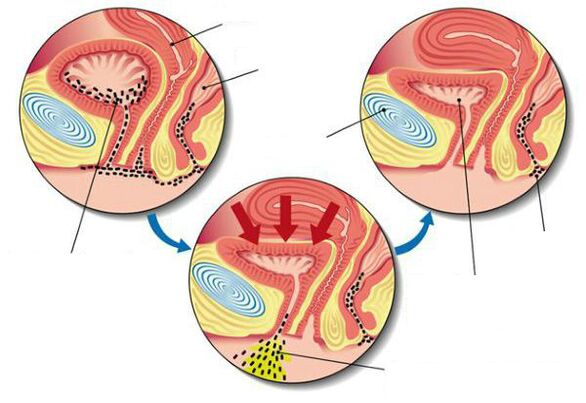 baktériumok a hólyagban cystitisben