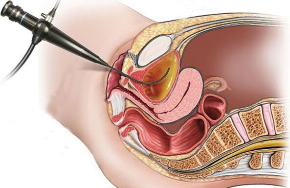 cisztoszkópia cystitis esetén